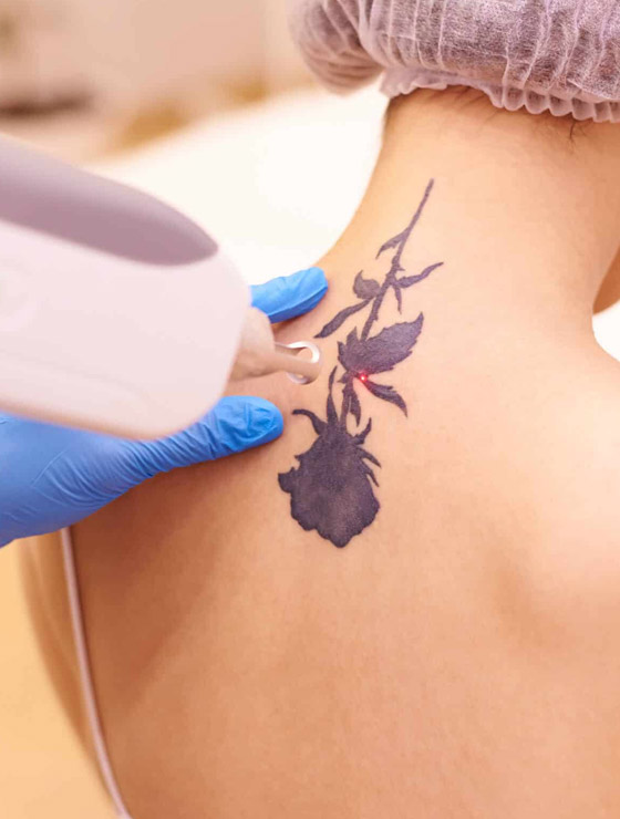 img-laser-tattooremoval-01